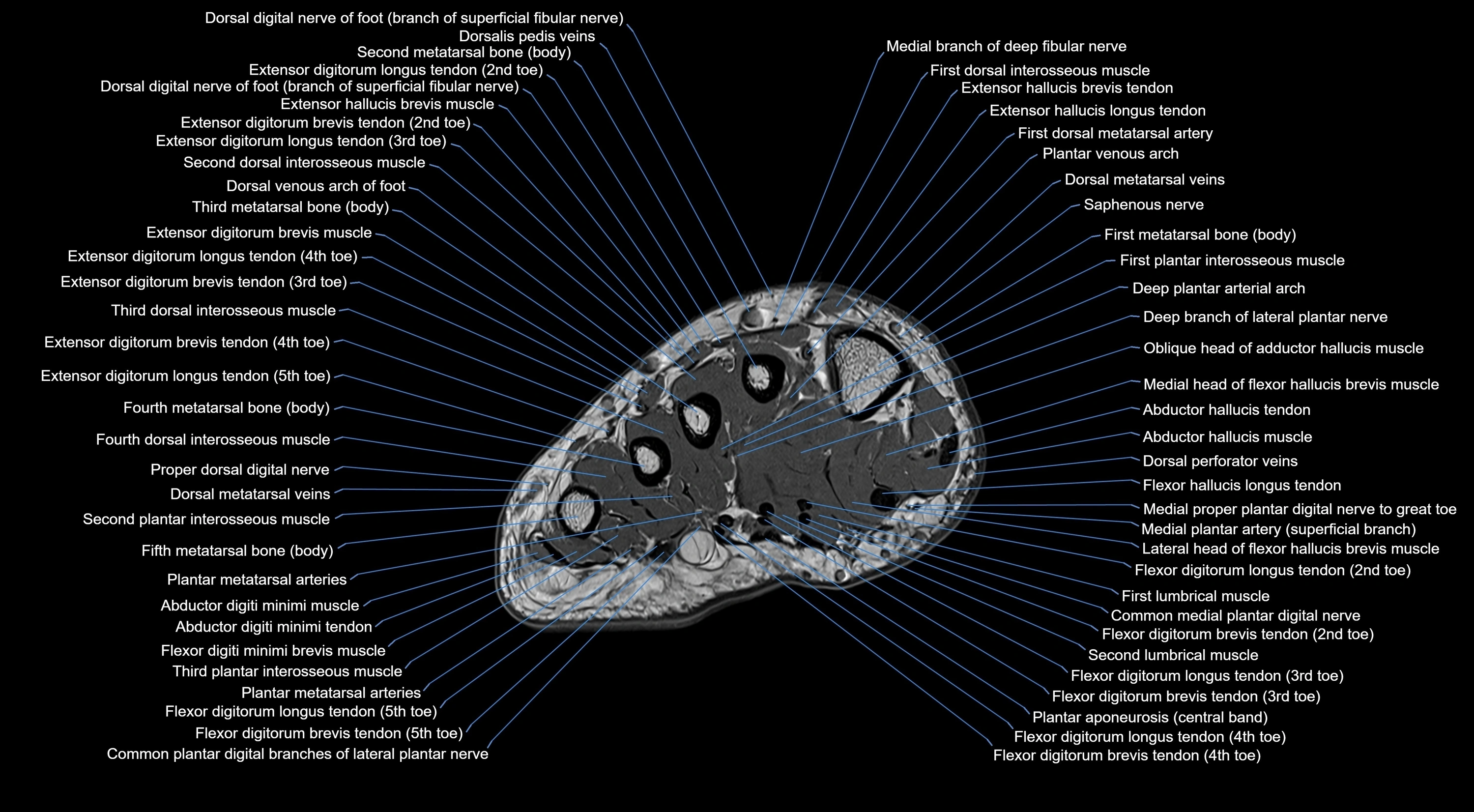 MRI mid foot coronal ligaments cross sectional anatomy 3T  radiology  image-img-00001-00003.webp